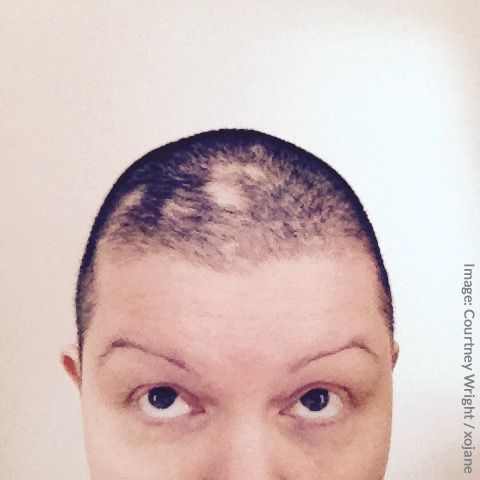 Woman Shaves Head To Cope With Trichotillomania