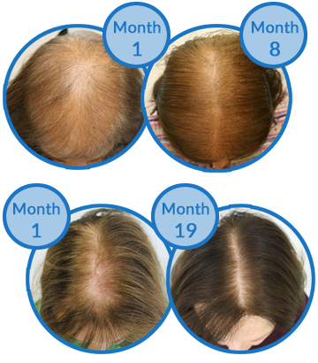 Belgravia Centre Female Pattern Hair Loss Treatment Success Stories
