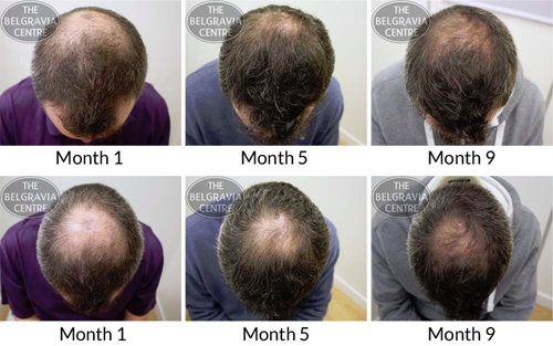 This Belgravia Male Hair Loss Client Restored His Confidence As Well As His Hair