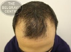 Frontal Balding