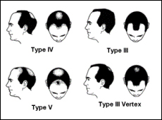 Norwood Scale of Hair Loss
