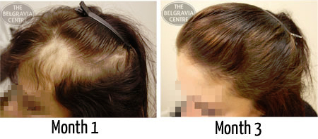 Female Alopecia Areata Patient - The Belgravia Centre Hair Loss Clinic