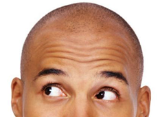 Reasons for hair loss in men