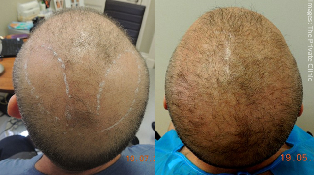Hair Transplant Before and After Images Using Chest Hair 