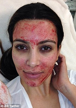 Kim Kardashian Vampire Blood Facial Used to Combat Baldness