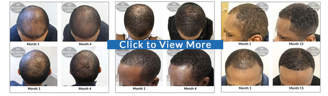 Male Pattern Hair Loss Treatment Success Stories Belgravia Centre Afro Hair Regrowth