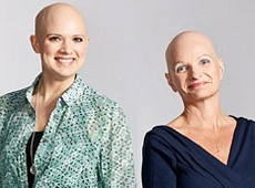 Alopecia Universalis and Alopecia Totalis