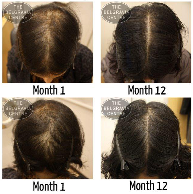 Miss Kalia's Telogen Effluvium and Female Hair Loss 'Before & During' Treatment Photoscans