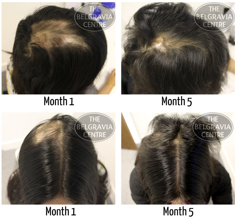 "I got my hair back within three months" - Alopecia Areata Patient on her hair loss treatment at The Belgravia Centre