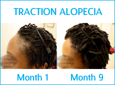 Traction Alopecia - The Causes and Treatments