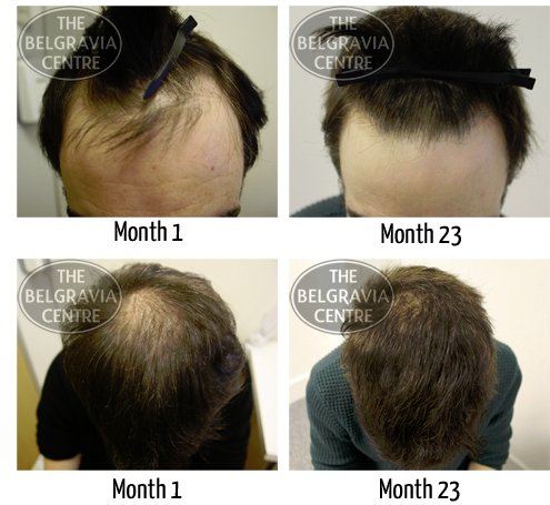 Belgravia patient successfully treated for male pattern hair loss similar to Marco Rubio
