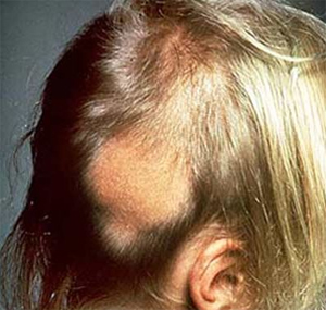 Alopecia in Children