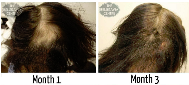 Belgravia Centre Female Alopecia Areata Hair Loss Success Story