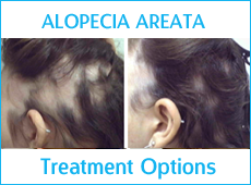 Alopecia Areata Treatment Options