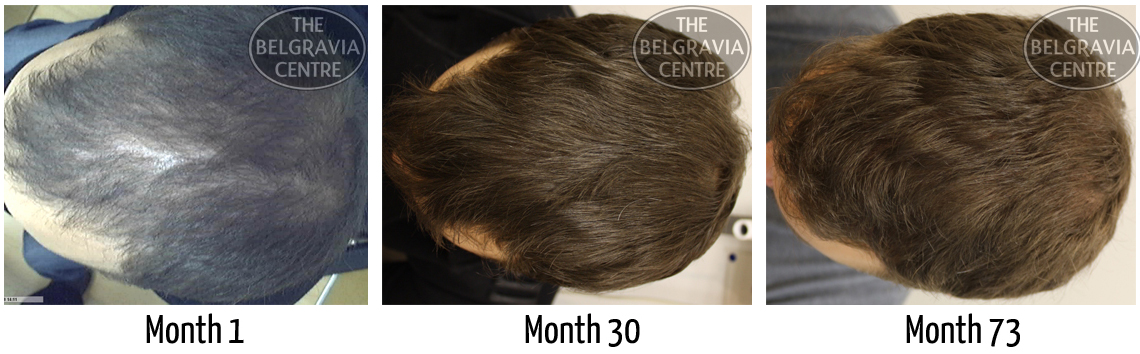 Male Hair Loss patient Successfully Treated by The Belgravia Centre