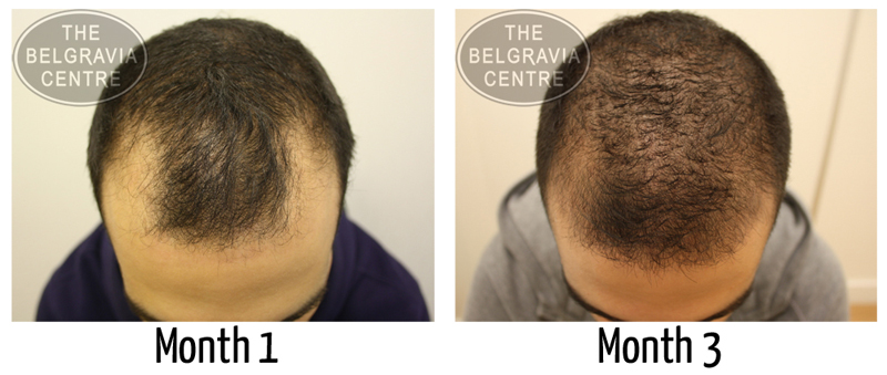 An example of one of our Hair Loss Success Story patients following treatment for a receding hairline caused by Male Pattern Baldness