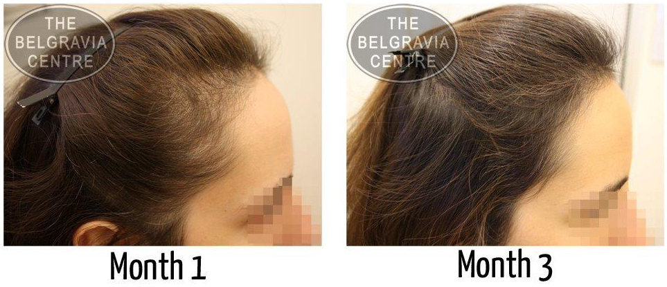 "The pace of hair loss has significantly reduced within the last month and on the photos during the check-up I can see a lot of new hair growing" - A Belgravia Centre Female Hair Loss Patient