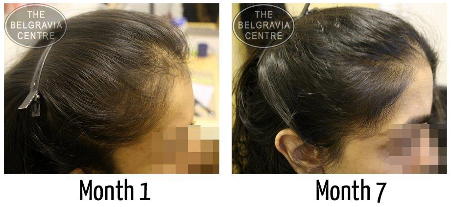“After my 3rd treatment, I can say that I can see the improvement of my hair.  Big thanks to Shamima, she has been great" - Female Hair Loss Patient treated by The Belgravia Centre