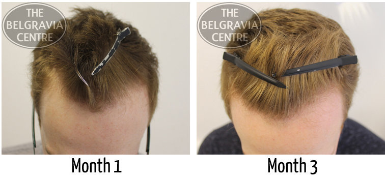 An example of Male Pattern Hair Loss successfully treated by The Belgravia Centre
