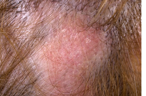 Hair Loss Caused by Systemic Lupus Erythematosus