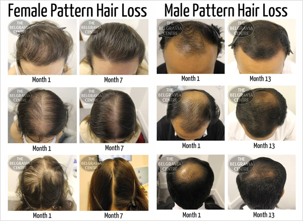 View Over 1,000 Patient 'Before & After' Images in our Hair Loss Success Stories