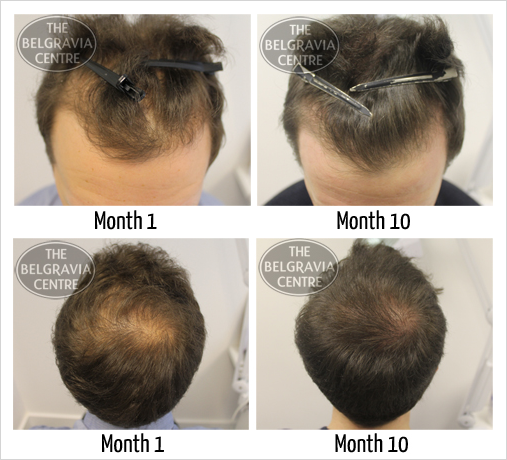 View Our Extensive 'Hair Loss Success Stories' Gallery to See Regrowth Results for Over 1,000 Belgravia Centre Patients