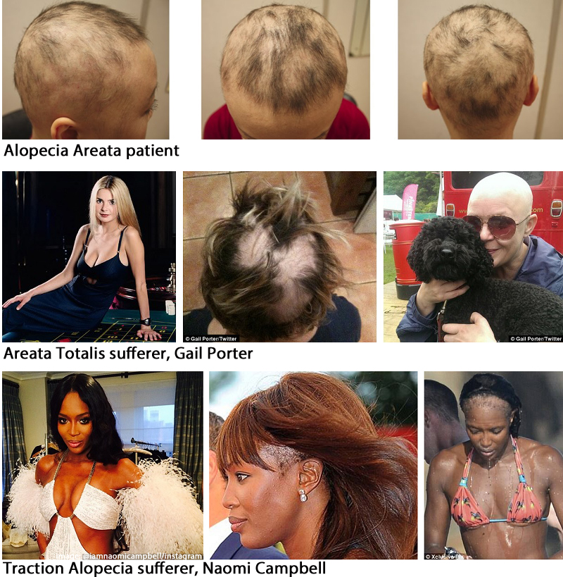Sufferers of various forms of alopecia and their resulting hair loss