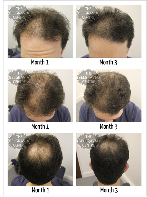 Example of Male Pattern Hair Loss being Successfully Treated by The Belgravia Centre