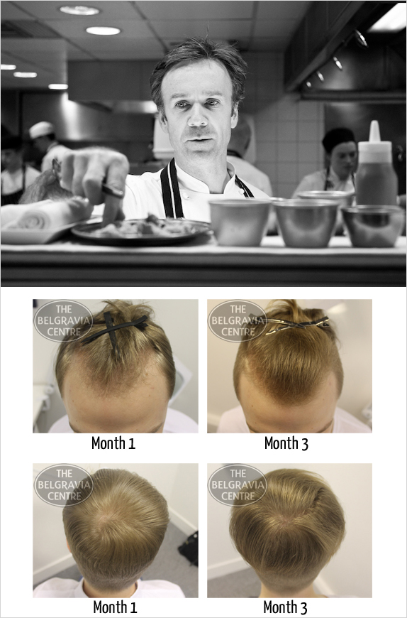 Chef, Marcus Wareing, and a Hair Loss Success Story showing a Belgravia Centre patient's results from treatment for Male Pattern Baldness hair loss