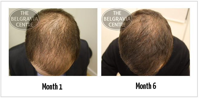 Successful Treatment for Hair Loss Caused by Male Pattern Baldness at The Belgravia