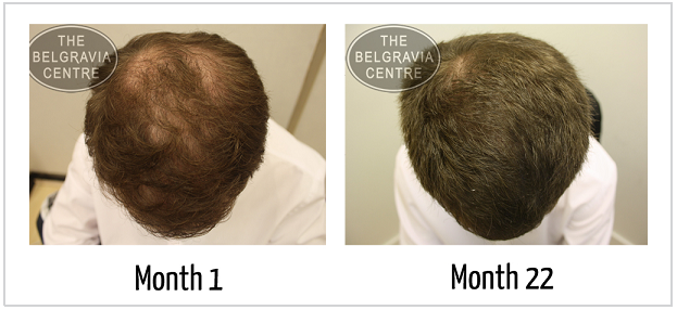 Male Pattern Baldness: Successful Regrowth Following Hair Loss Treatment from The Belgravia Centre