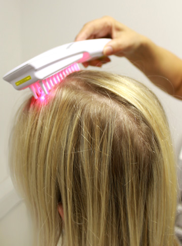 Thinning Hair Women Female Pattern Hair Loss