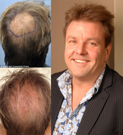 Was Martin Roberts Given Bad Hair Loss Treatment Advice?
