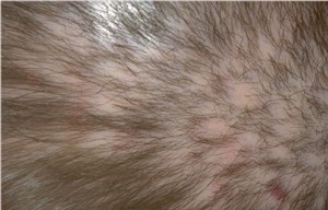 pseudopelade scarring alopecia