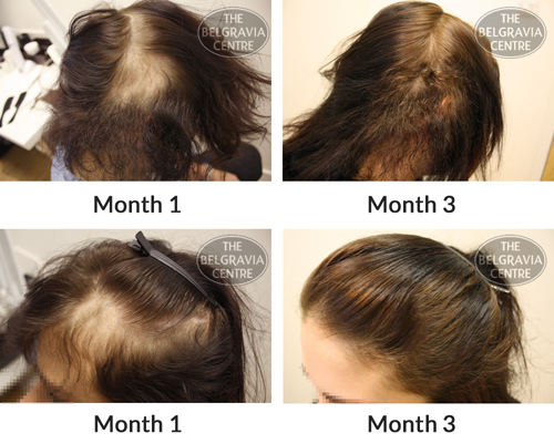 Alopecia Areata Hair Loss Successfully Treated By The Belgravia Centre