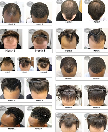 View Belgravia Men's Hair Loss Treatment Success Stories - Hair Regrowth Solutions Male Pattern Baldness