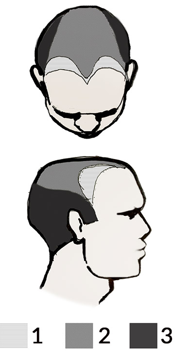 Receding Hairline Widow's Peak Male Pattern Baldness diagram picture hair loss