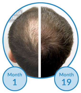 male-hair-loss-treatment-belgravia-centre-client-success-story-thinning-crown