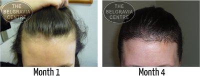Trinity Postpartum Hair Loss Photoscans The Belgravia Centre