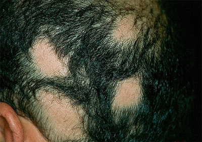 Alopecia Areata in Men The Belgravia Centre