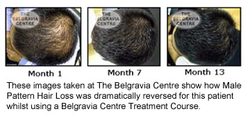 Male Pattern Hair Loss Reversed The Belgravia Centre
