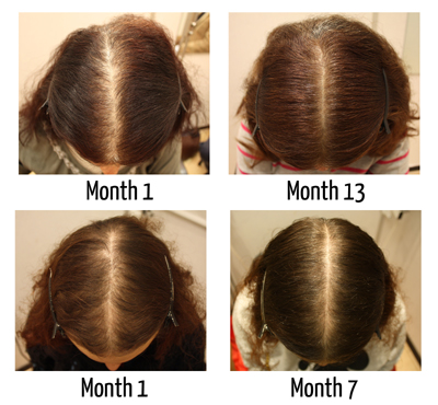 Women's Hair Loss Treatment