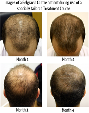 Male Pattern Hair Loss 1 The Belgravia Centre