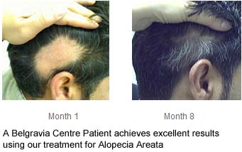 Alopecia Areata Zabi The Belgravia Centre for Hair Loss