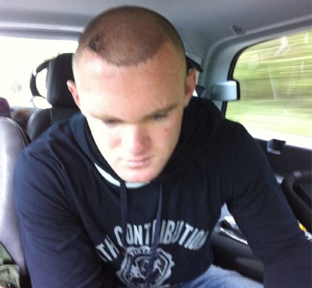 Rooney Hair Transplant