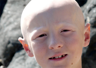 Boy Alopecia copy