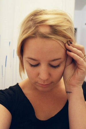 Female Hair Loss: Conditions and Possible Treatments