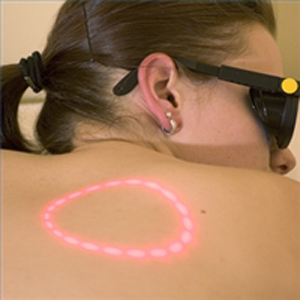 Infrared Laser Treatment