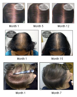 Causes of Female Hair Loss