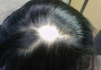 Child Hair Loss - Alopecia Areata
